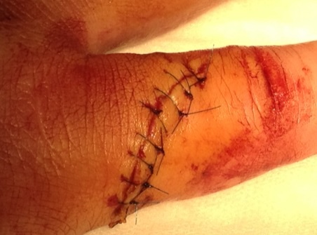 fireside friend injury.jpg