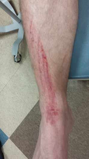 foot injury.jpg