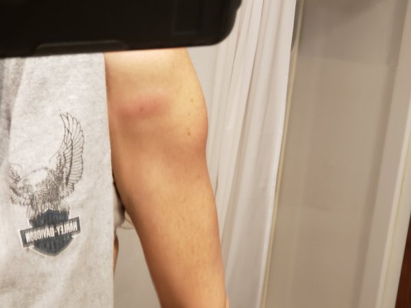 welt front and swelling.jpg