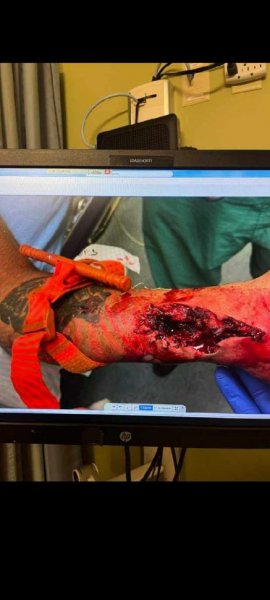 chainsaw - bad wound.jpeg