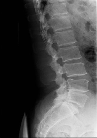 Spine1 normal.jpg