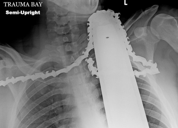Chainsaw in neck.jpg